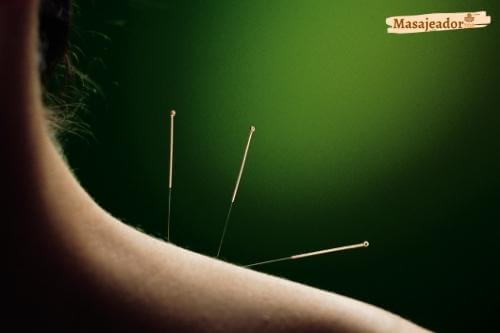 qué es la acupuntura